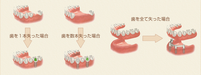 インプラント治療